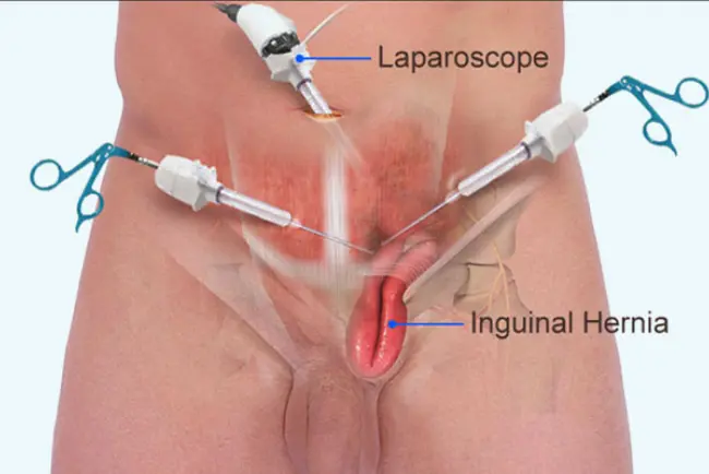 Laparoscopic Hernia Surgery