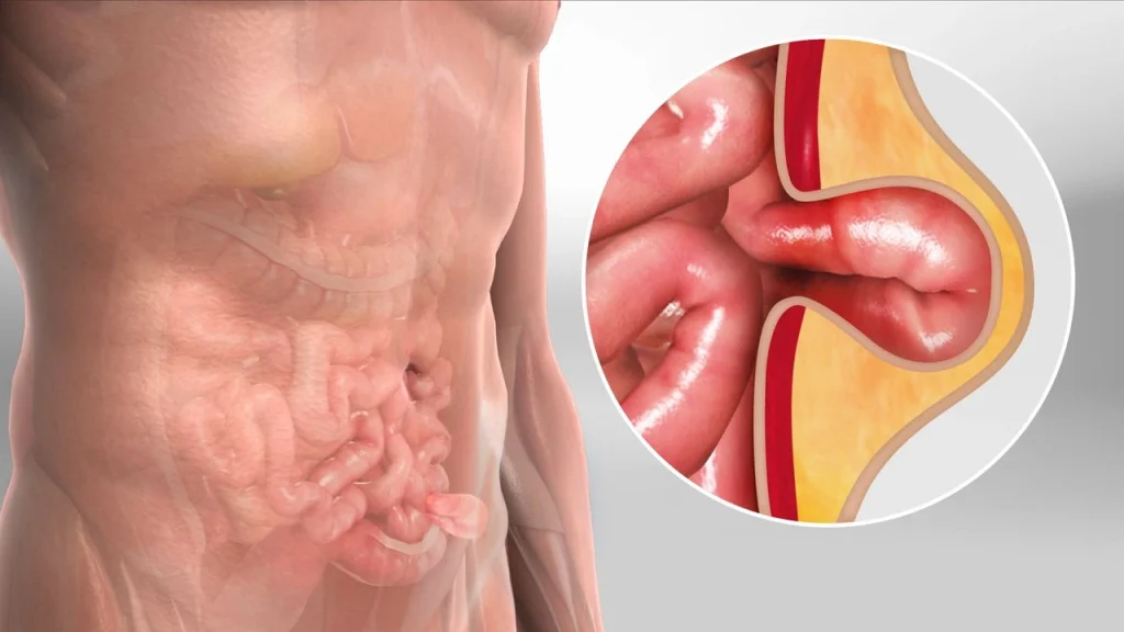 hernia
